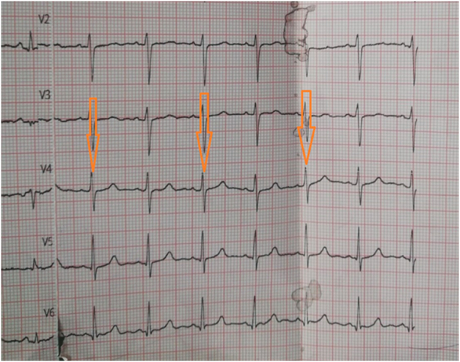 Cardiac tamponade with scleroderma renal crisis in systemic sclerosis: a case report.