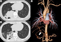 A Case of Hybrid of Congenital Pulmonary Airway Malformation and Anomalous Systemic Blood Supply Presenting Elevated Serum Levels of Carbohydrate Antigen 19-9.