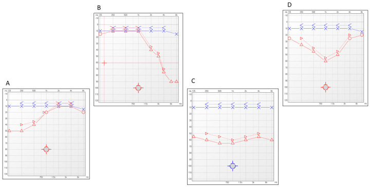 Audiogram Shape: Does It Have a Significant Prognostic Role in Idiopathic Sudden Sensorineural Hearing Loss Outcome?