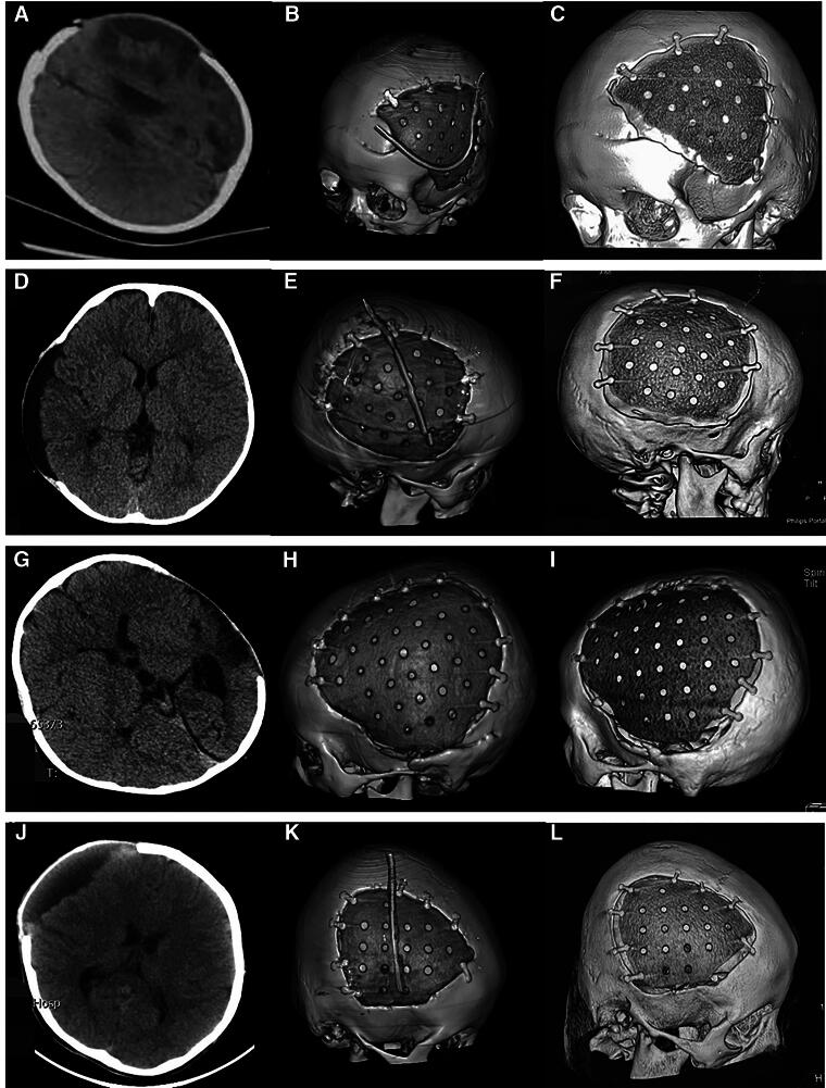 Gap Expansion Between Cranial Bone and Polyether Ether Ketone Implant in Cranioplasty of Pediatric Patients after Decompressive Craniectomy at Follow-up.
