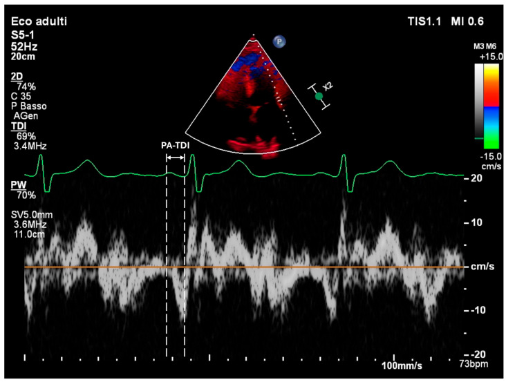 Left Atrial Mechanics and Remodeling in Paroxysmal Atrial Fibrillation: Introducing the EASE Score for Pre-Ablation Risk Prediction.