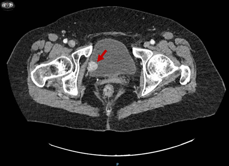 An Unusual Entity in Urology: Urinary Bladder Paraganglioma.