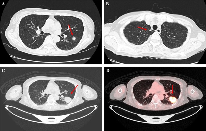 Pulmonary Cryptococcosis With Rapid Growth on Positron Emission Tomography/Computed Tomography.