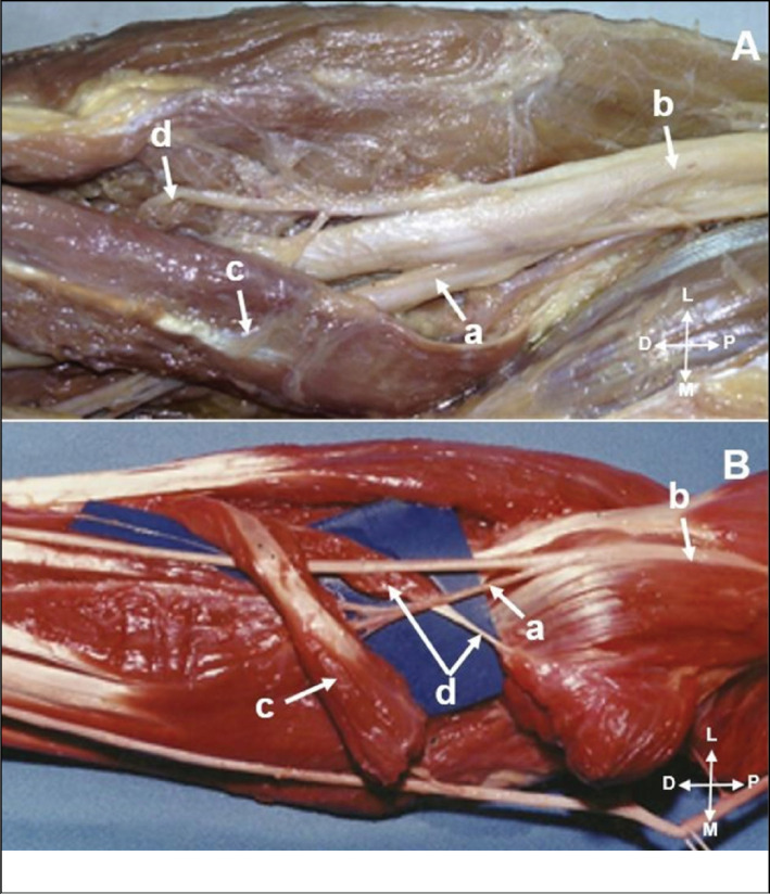 ANTERIOR INTEROSSEOUS NERVE TRANSFERS FOR THE TREATMENT OF RADIAL NERVE INJURIES.