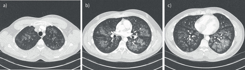 Acute post-operative respiratory insufficiency and diffuse alveolar haemorrhage in a young and healthy adult.