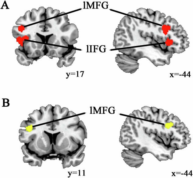 Unraveling consistently altered brain activations of language deficits in schizophrenia: evidence from ALE meta-analysis.