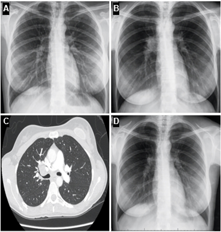 Behçet's disease and tuberculosis: unmasking infection behind a suspected flare.
