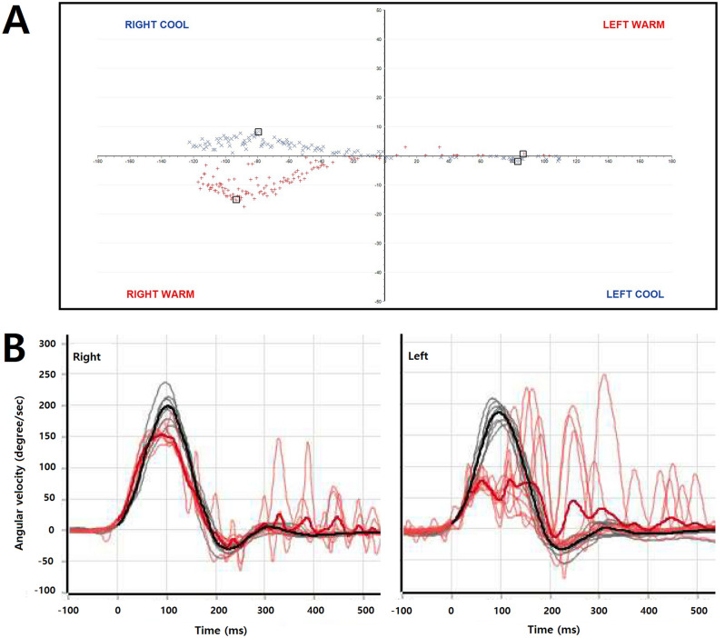 Dizziness and spatial disorientation in patients with transient global amnesia: clinical and vestibular correlates.