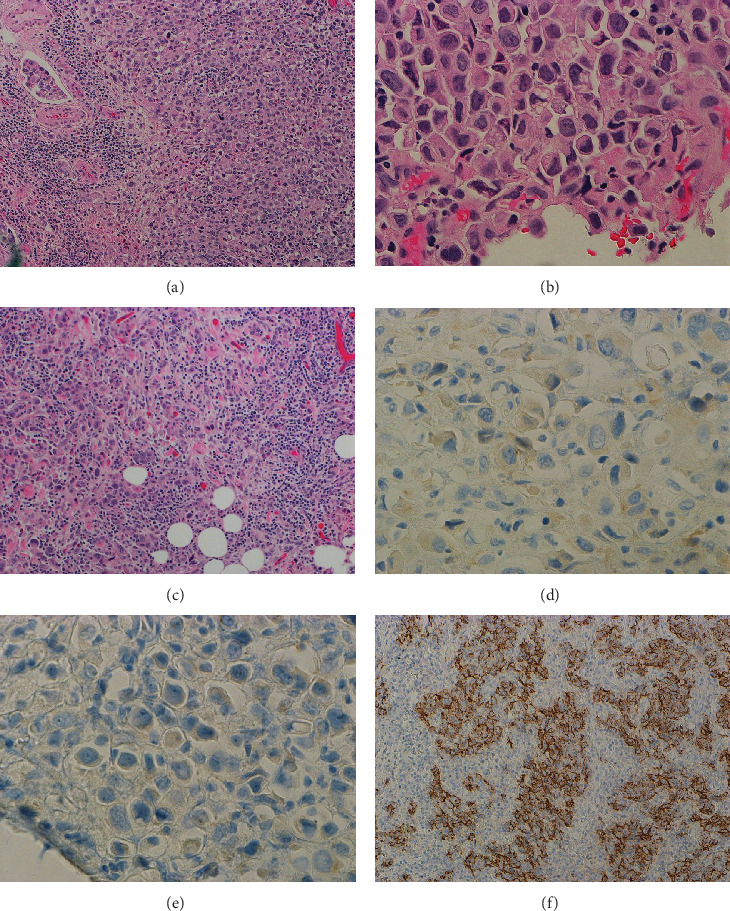 Simultaneous Lymphoepithelioma-Like and Plasmacytoid Subtypes of Urothelial Carcinoma, Along With Prostatic Adenocarcinoma With Clinical Follow-Up.