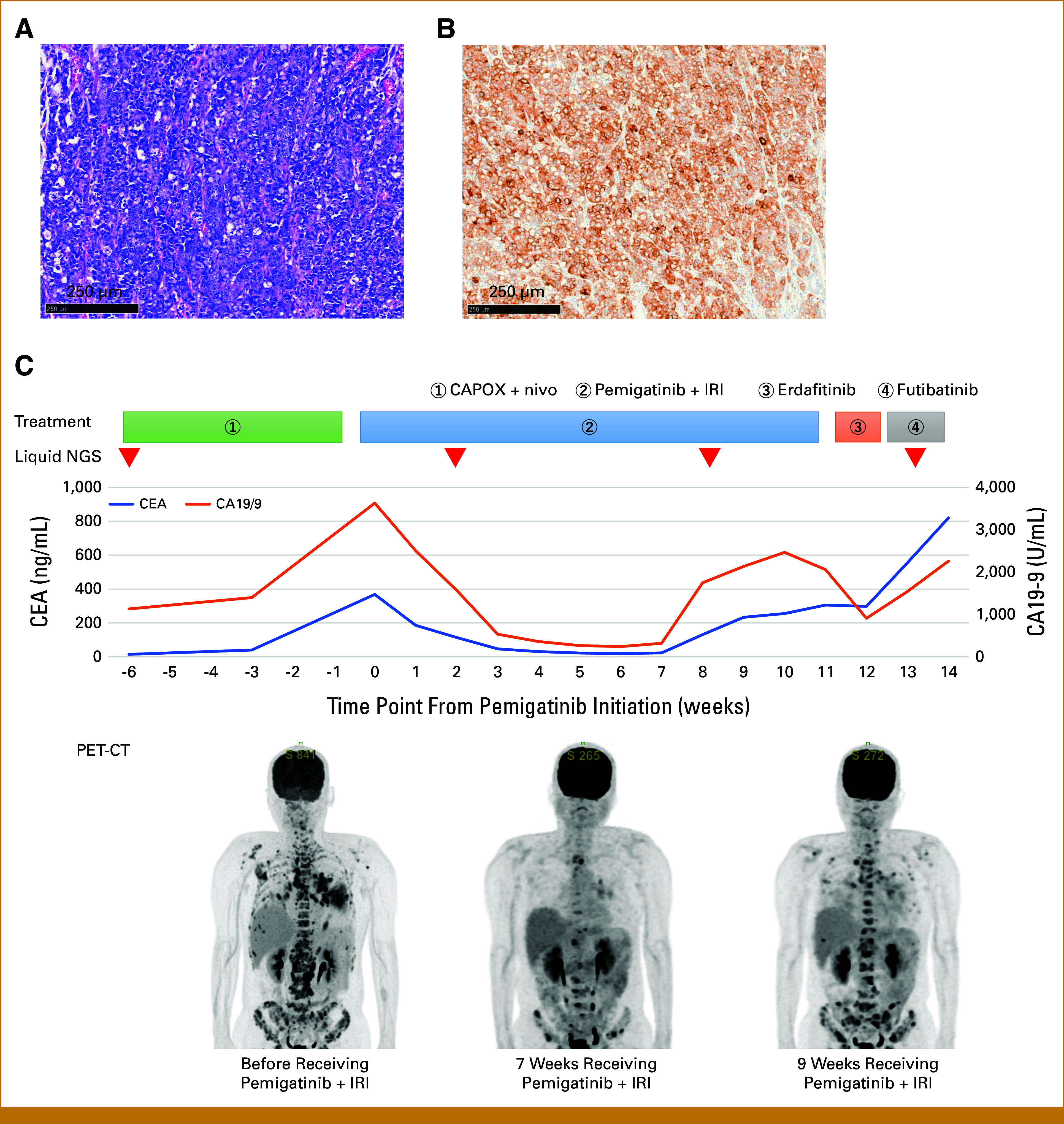 Clinical Significance of Extrachromosomal DNA in <i>FGFR2</i>-Amplified Gastric Cancer: Therapeutic Implications From Clinical Experience.