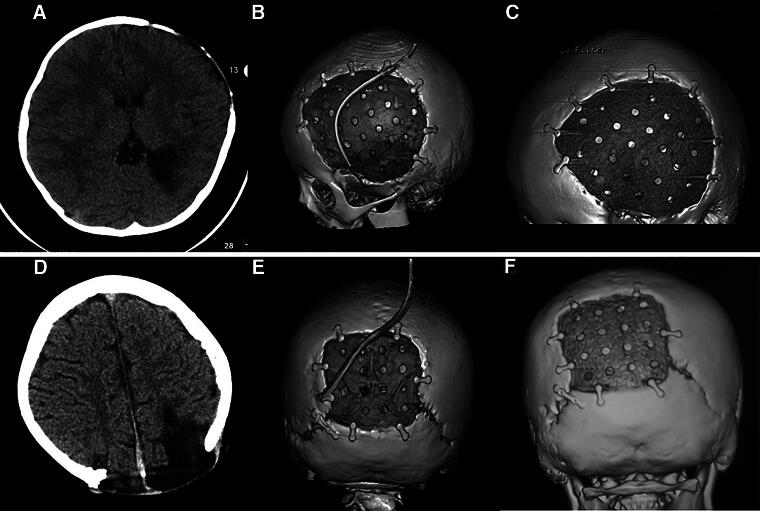 Gap Expansion Between Cranial Bone and Polyether Ether Ketone Implant in Cranioplasty of Pediatric Patients after Decompressive Craniectomy at Follow-up.
