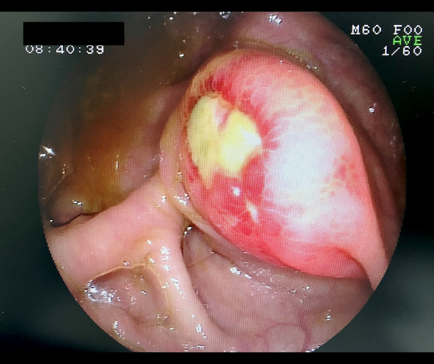 Submucosal Cecal Lipoma Mimicking Malignancy in a 51-Year-Old Man: A Diagnostic Challenge in Routine Colonoscopy.