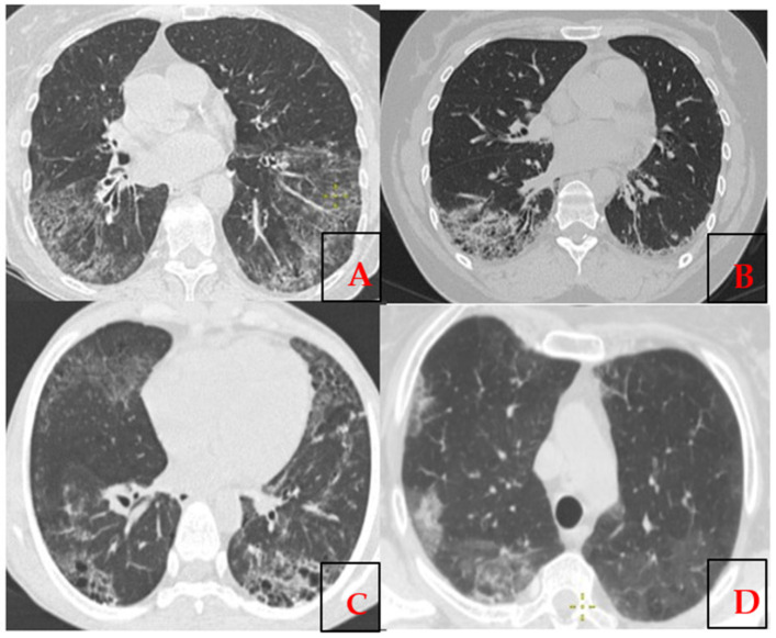 Systemic Sclerosis with Interstitial Lung Disease: Identification of Novel Immunogenetic Markers and Ethnic Specificity in Kazakh Patients.