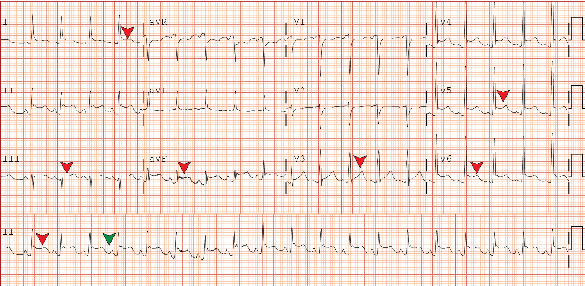 Pneumococcal Pyopericardium With Xiphoid Osteomyelitis in HIV/AIDS: A Rare but Potentially Fatal Complication.
