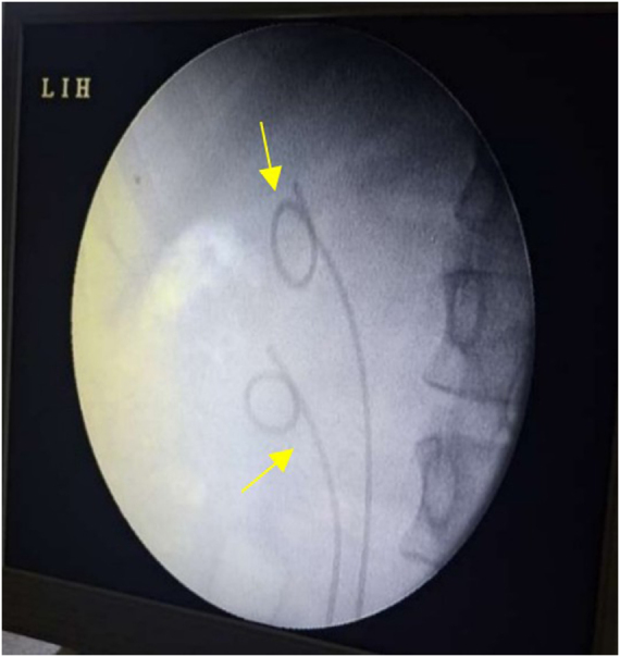 Endoscopic thulium-fiber laser deroofing and dual stenting for adult duplex ureterocele with preserved upper renal moiety: a case report.