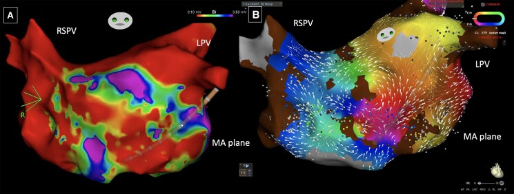 Role of atrial fibrillation ablation in the management of atrial mitral and atrial tricuspid regurgitation: a case report.