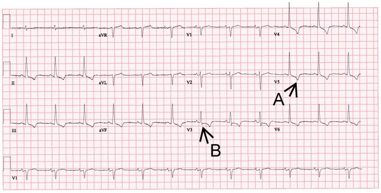 Dietary lifestyle changes unexpectedly causing digoxin intoxication with cardiogenic shock: a grand round case report.