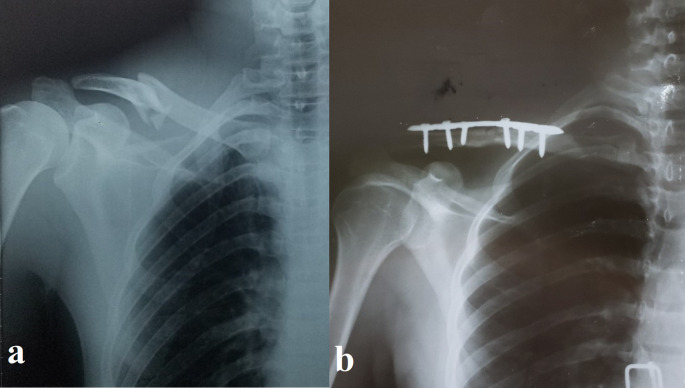 Functional Outcomes of Displaced Midshaft Clavicular Fractures Treated with Precontoured Locked Plates: A Prospective Study.