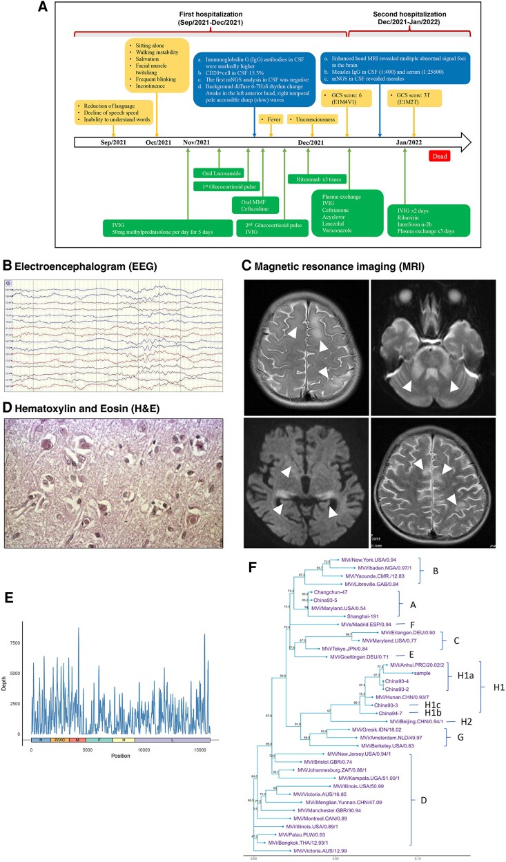 A Case of Measles Virus-caused Subacute Sclerosing Panencephalitis Diagnosed by Molecular and Clinical Analysis.