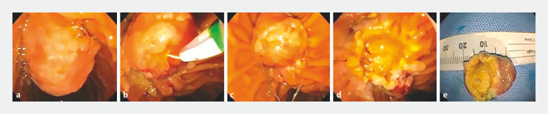 Endoscopic papillectomy of major papilla lesions: Single tertiary care center experience.