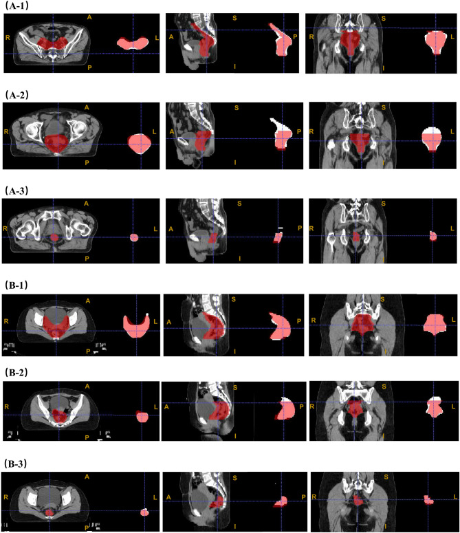 CT-based auto-segmentation of multiple target volumes for all-in-one radiotherapy in rectal cancer patients.