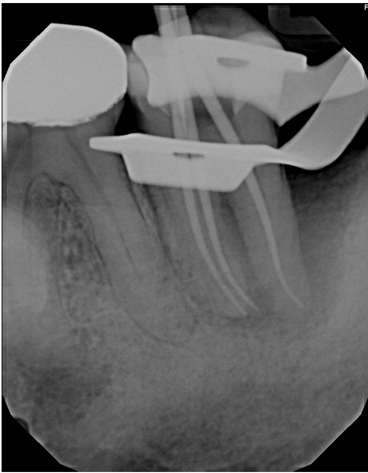 Multidisciplinary management of an endo-perio lesion complicated by a cemental tear: a case report.