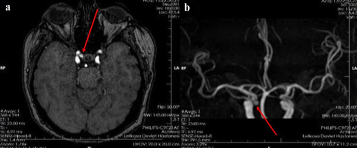 A Successful Treatment of Hemifacial Spasm After Flow Diverter Stent Placement for Ipsilateral Internal Carotid Artery Saccular Aneurysm.