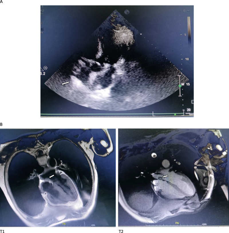A comorbidity of cardiac atherosclerotic disease with cardiac myxomas being concomitantly treated by coronary artery bypass grafting coupling with tumor resection: a case report.