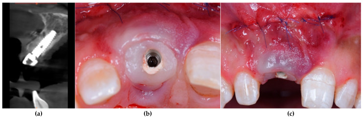 Comparative Evaluation of Customized CAD/CAM vs. Stock Titanium Abutments for Immediate Implant Placement in Class II Extraction Sockets: A Randomized Controlled Trial.
