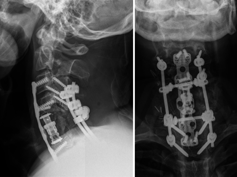 Long-term follow-up after cervical en bloc resection as salvage surgery of spinal chondrosarcoma: illustrative case.