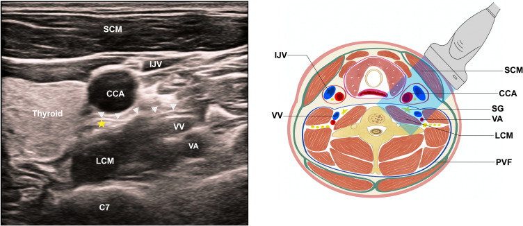 Effect of Stellate Ganglion Block on Preventing Atrial Fibrillation After Esophagectomy: A Double-Blind Randomized Controlled Trial.