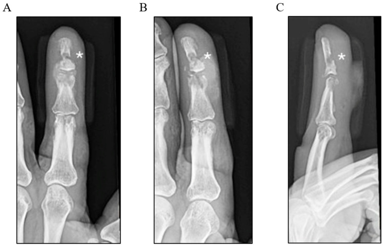 The First <i>Schaalia</i> (Formerly <i>Actinomyces</i>) <i>Canis</i>-Related Osteomyelitis Requiring Surgical Intervention.