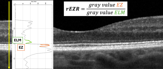 Early photoreceptor assessment as a predictor for visual acuity gain after vitrectomy for macula-off retinal detachment.