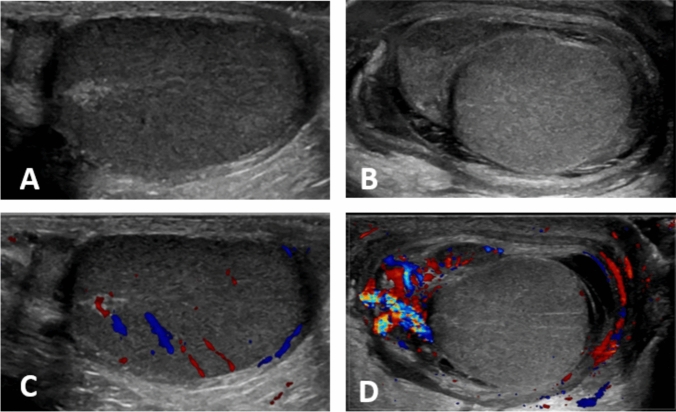 Clinical characteristics of pediatric acute epididymitis: a single institute review of 142 cases.