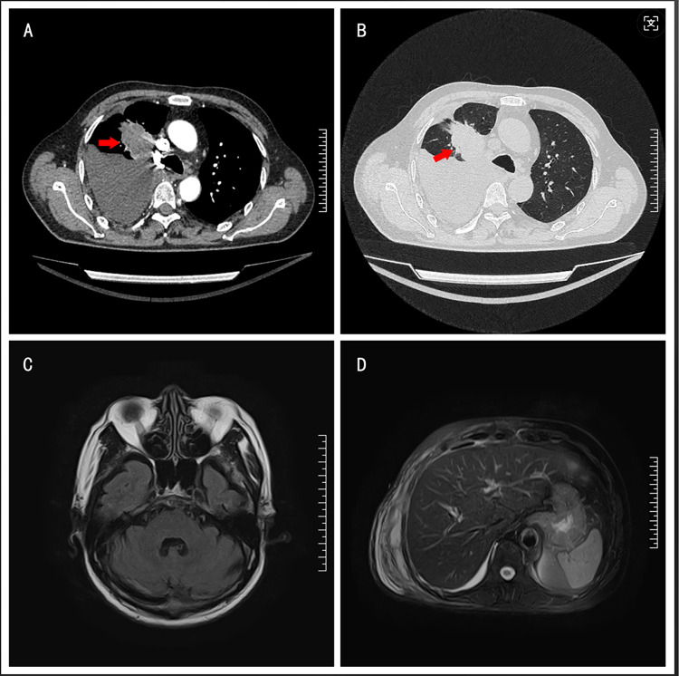 Dual EGFR L858R and KRAS G12A Mutations in Lung Adenocarcinoma: A Rare Case Report and Literature Review.