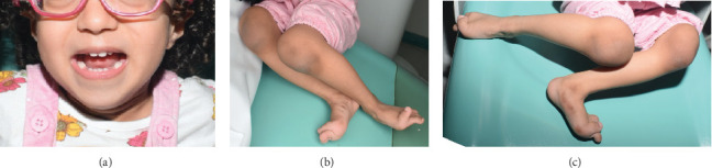 The Intersection of Genitopatellar Syndrome and Oral Health: A Case Report at Saudi Arabia.