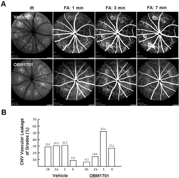 OBM1701 Alleviates Choroidal Neovascularization in Experimental Animals Via Suppressing the Expression of HIF-1α in Retinal Pigment Epithelial Cells.