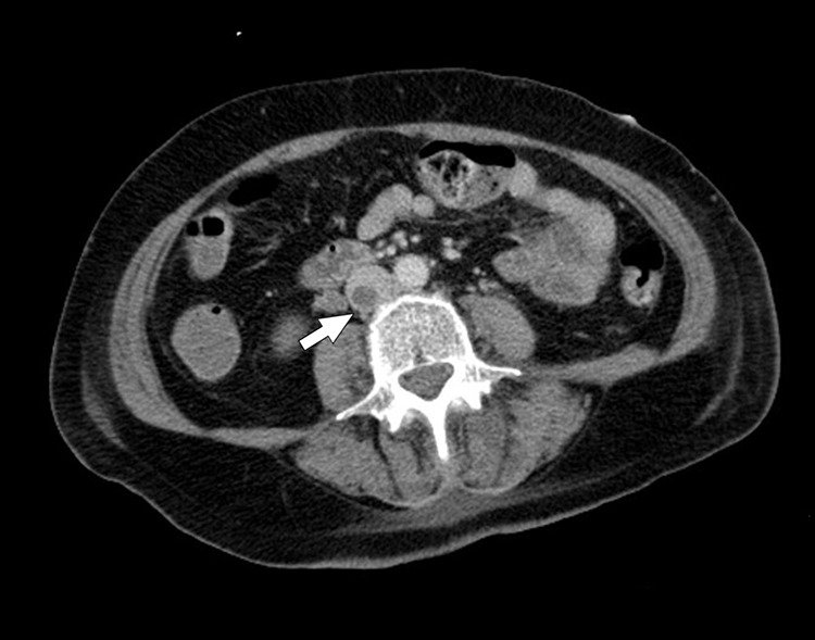 Inferior Vena Cava Septic Thrombophlebitis: A Severe Complication of Paraspinal Steroid Injection Leading to Methicillin-Resistant <i>Staphylococcus aureus</i> Dissemination.