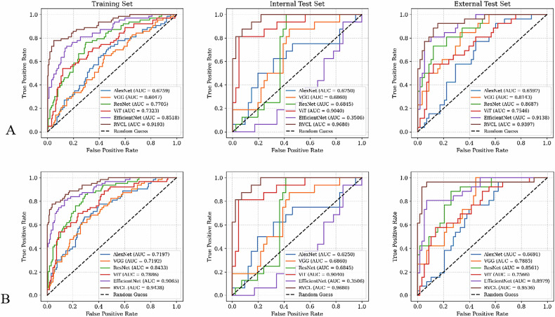 Macrotrabecular-massive subtype in hepatocellular carcinoma based on contrast-enhanced CT: deep learning outperforms machine learning.