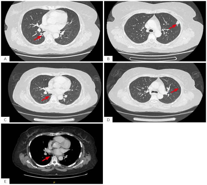 The Balance Between Autoimmunity and Infection: A Case Report of Concomitant Pathology of Pulmonary Nocardia and Granulomatosis with Polyangiitis at Initial Presentation.