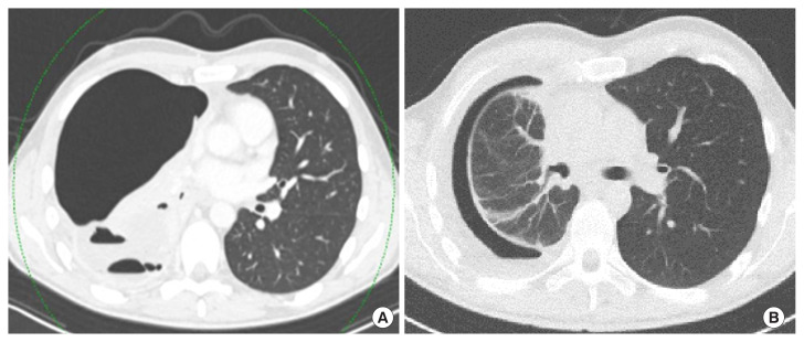 Unilateral cystic and bullous lung changes in a patient treated with brigatinib: a case report.