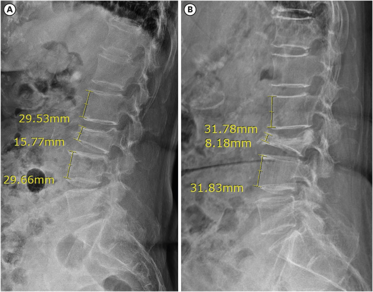 Compression Rate Progression of Osteoporotic Vertebral Compression Fracture in Conservative Treatments.