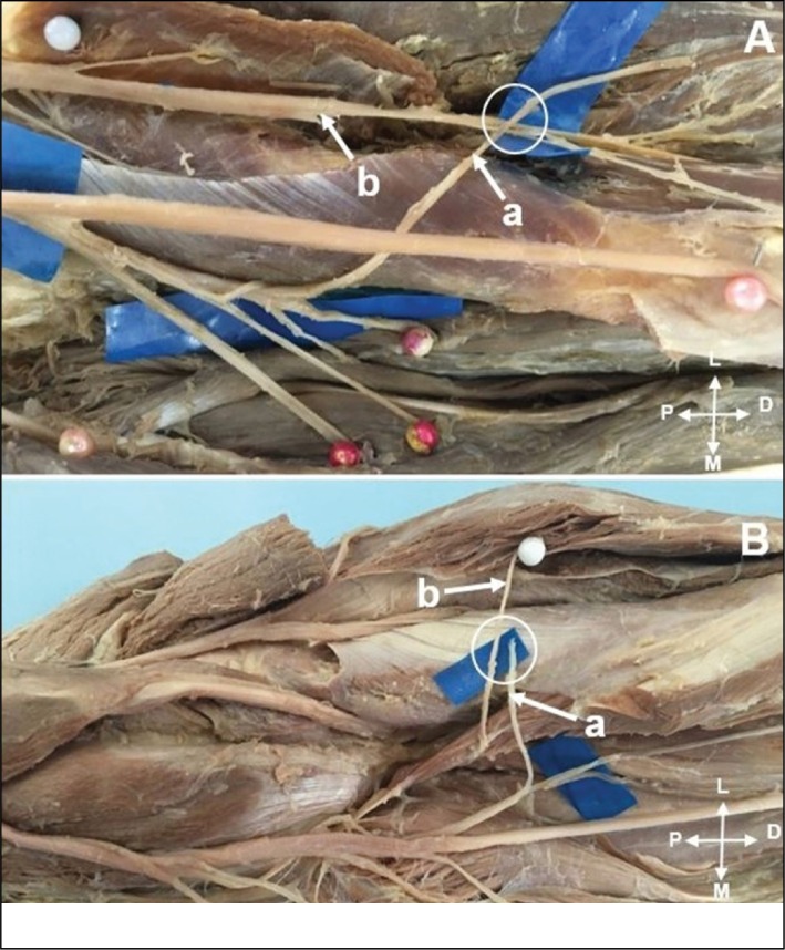 ANTERIOR INTEROSSEOUS NERVE TRANSFERS FOR THE TREATMENT OF RADIAL NERVE INJURIES.