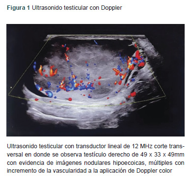 [Primary testicular lymphoma with extranodal involvement in the stomach. Case report].