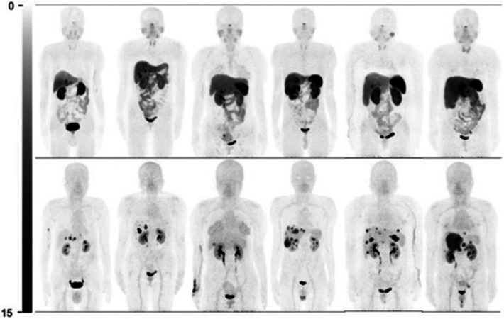Targeted radionuclide therapy and diagnostic imaging of SSTR positive neuroendocrine tumors: a clinical update in the new decade.
