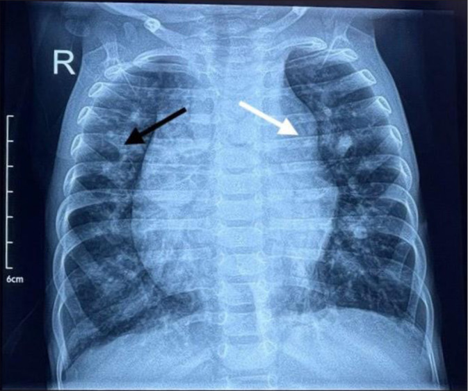 Mind the right ventricle: Tackling right heart dysfunction in left ventricular diverticulum with omphalocele.