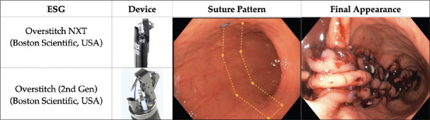 Recent advances in bariatric endoscopy for obesity management: expanding the therapeutic spectrum.