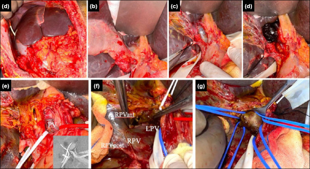 Tangential gunshot injury of the right portal vein branch resulting in subacute main portal vein thrombosis: Successful treatment without hepatectomy