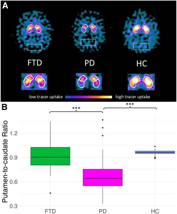 Striatal dopaminergic patterns and clinical features in frontotemporal dementia.