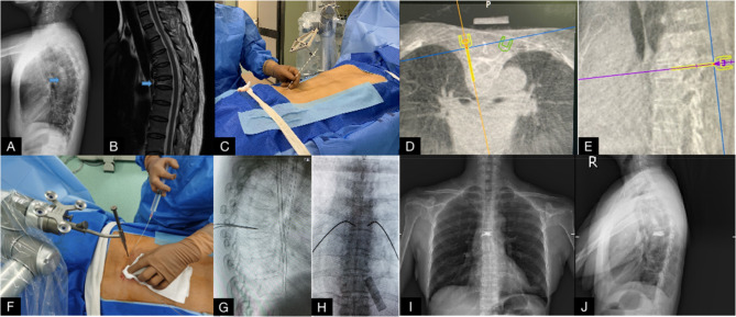 TiRobot-assisted percutaneous vertebroplasty in the management of middle and upper thoracic osteoporotic vertebral compression fracture.